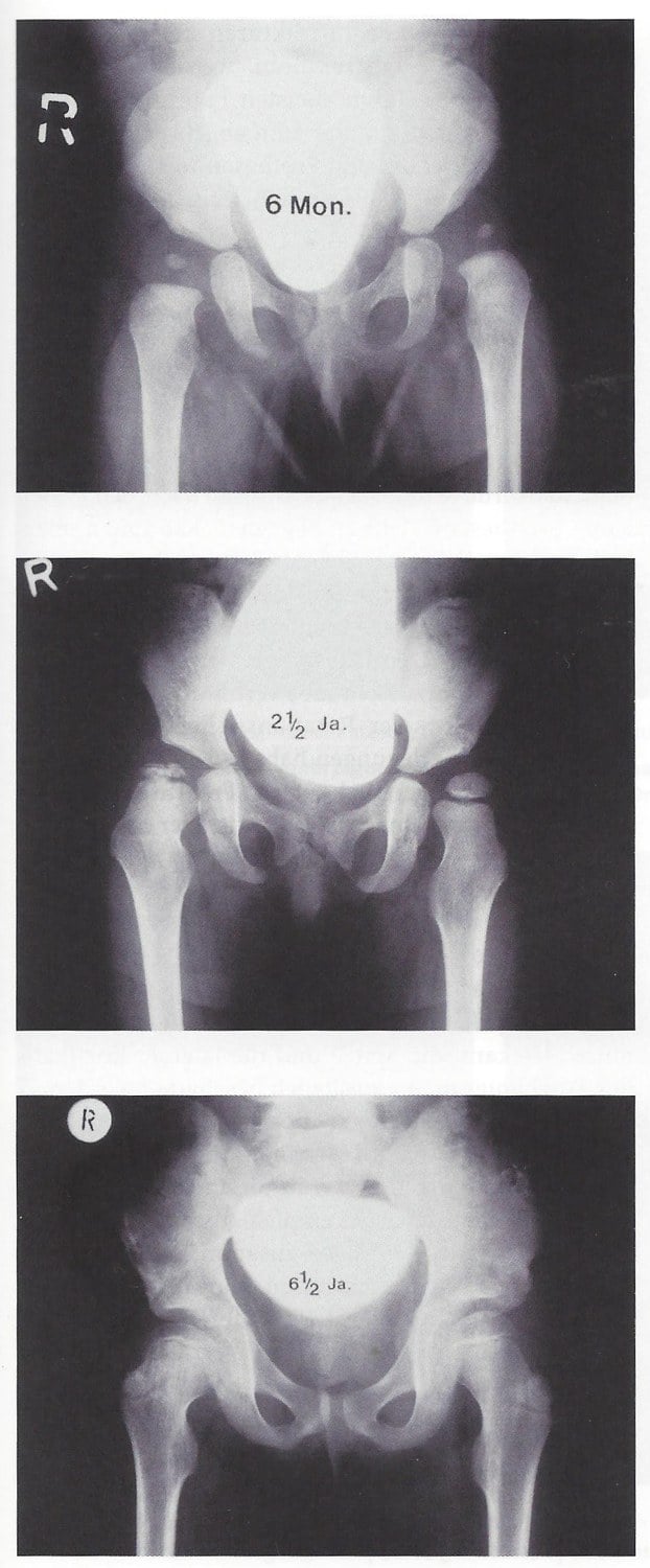 Three-panel AP pelvis radiographic series of an untreated right Perthes followed over years, progressing to a flattened, enlarged femoral head.