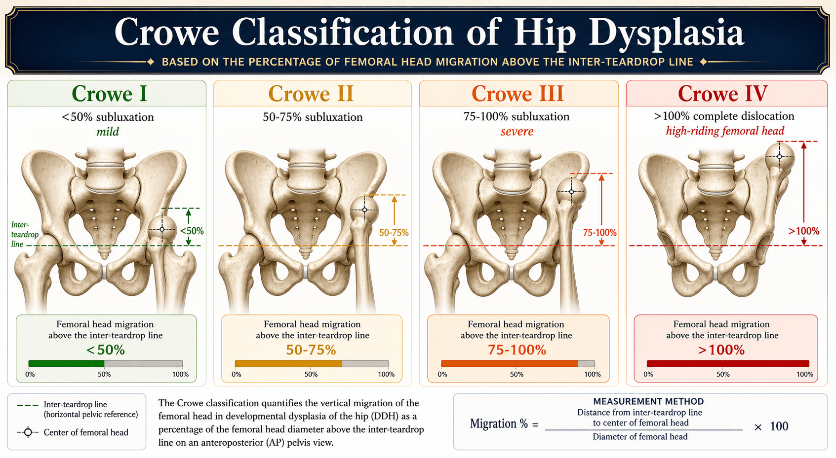 Crowe classification of hip dysplasia