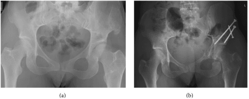 Pre-operative and post-operative AP pelvis radiographs showing periacetabular osteotomy for adult hip dysplasia
