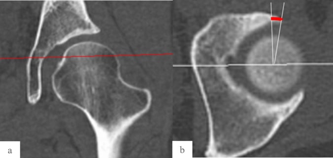 Coronal and axial CT images showing acetabular anteversion angle measurement