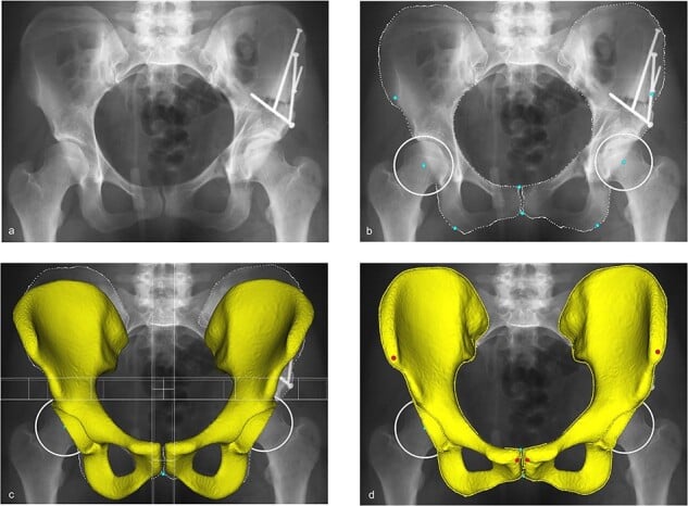 Radiographs and 3D pelvic model demonstrating PAO acetabular reorientation
