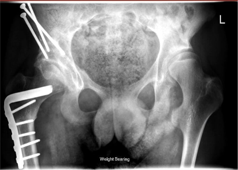 Postoperative radiograph of combined periacetabular osteotomy and proximal femoral osteotomy