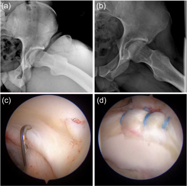 AP and false-profile radiographs and arthroscopic views of dysplastic hip labral repair