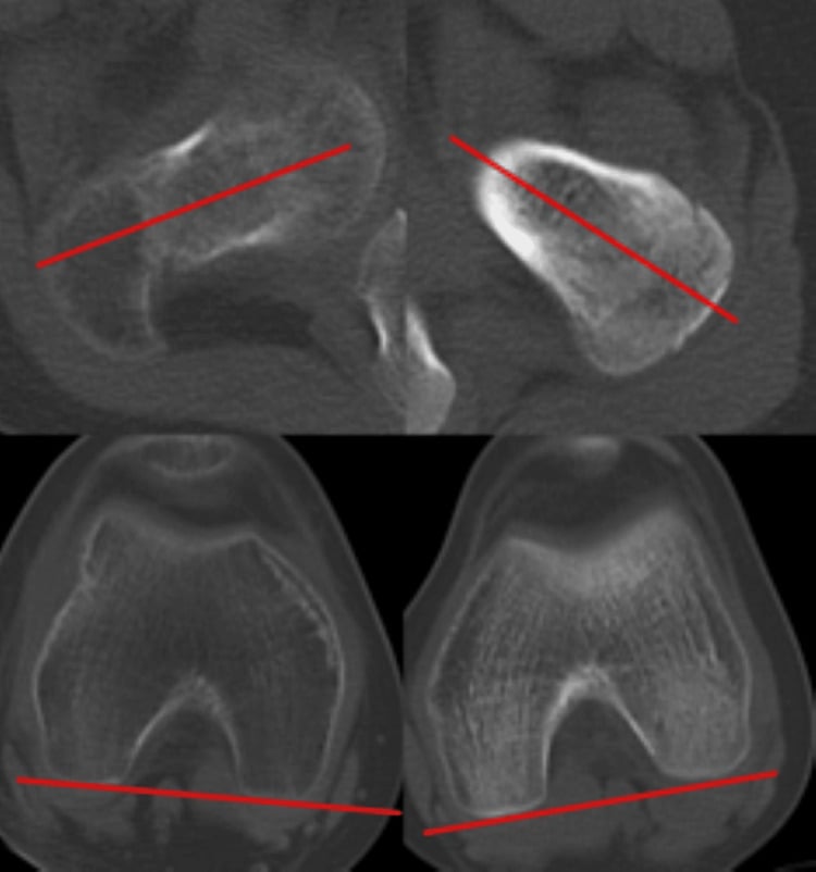 Axial CT scans confirming femoral neck anteversion angle measurement