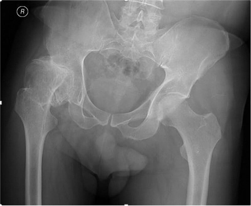 AP pelvic radiograph demonstrating Crowe IV dysplastic hip with false acetabulum