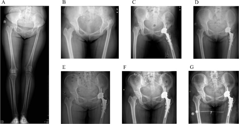 Serial pelvic radiographs of Crowe IV dysplastic hip before and after THA