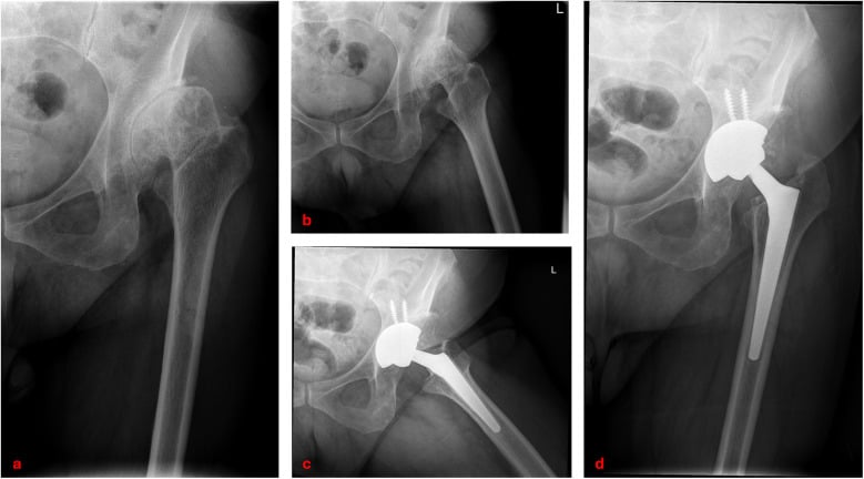 Preoperative and postoperative radiographs of Crowe IV THA with subtrochanteric shortening osteotomy