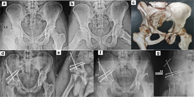 Preoperative radiographs, 3D CT, and postoperative radiographs of Ganz PAO