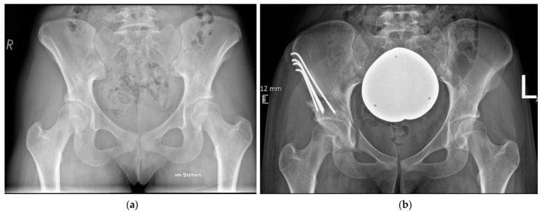 Preoperative and postoperative radiographs of Bernese periacetabular osteotomy