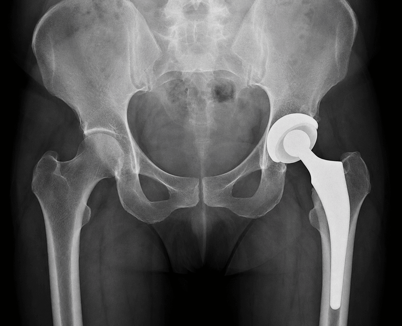 AP pelvis radiograph showing a total hip replacement, the native contralateral hip shown for comparison.