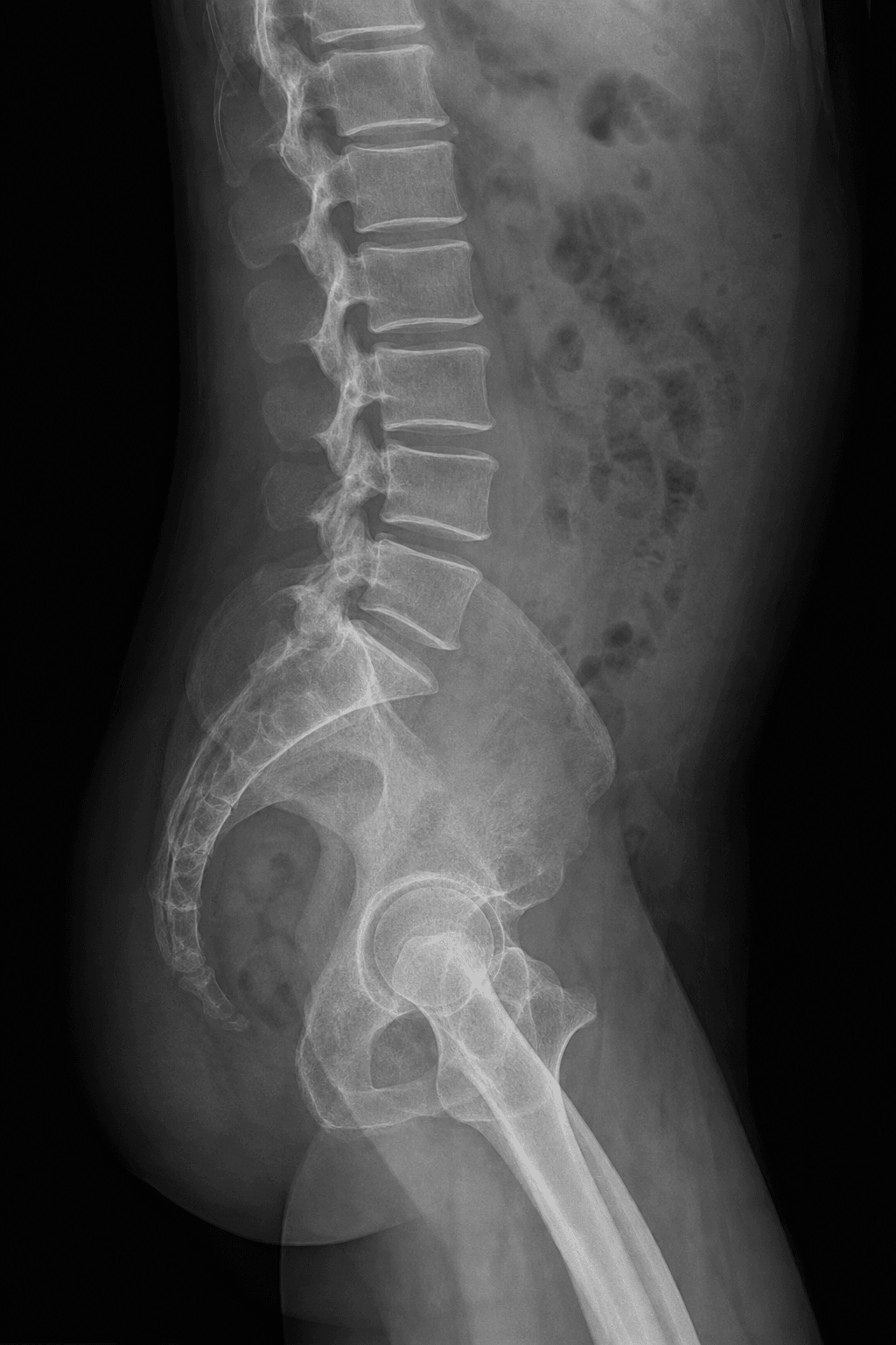 Standing lateral spinopelvic radiograph showing the lumbar spine, sacrum, pelvis and both hips used to measure spinopelvic parameters.