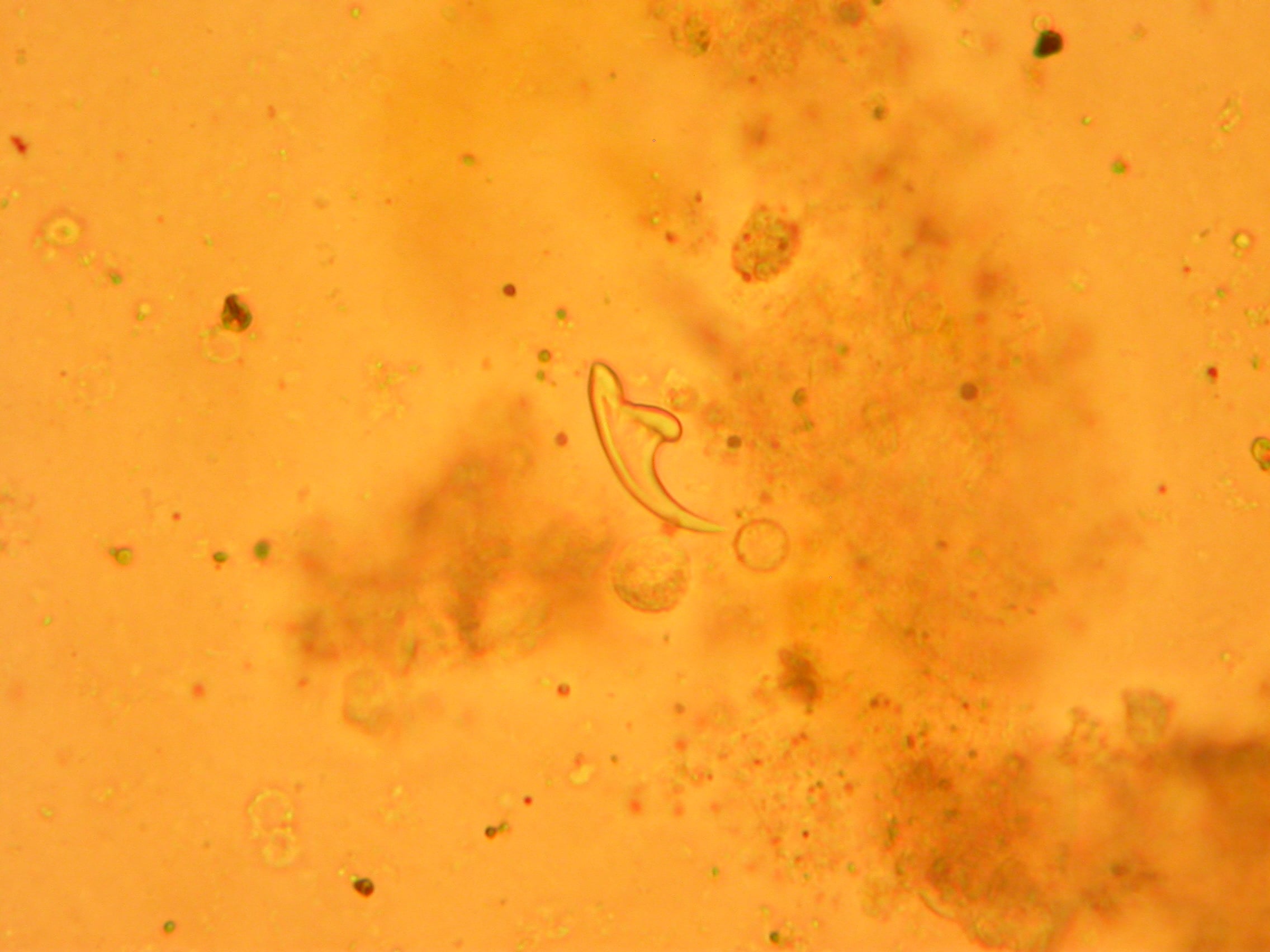 Light microscopy of hydatid cyst fluid containing an isolated hooklet of Echinococcus granulosus.
