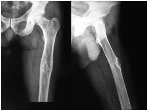 Radiographs of left femur with expansile lytic lesions, cortical thinning and an anterolateral cortical defect