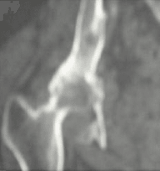 CT of pelvis showing destroyed hip with femoral head migrated superiorly into the iliac bone