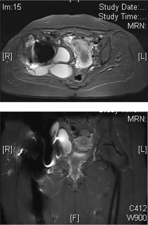 MRI scans demonstrating recurrent multiple hydatid cysts