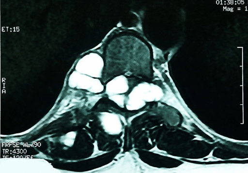 Axial MRI of spine showing cysts compressing the spinal cord