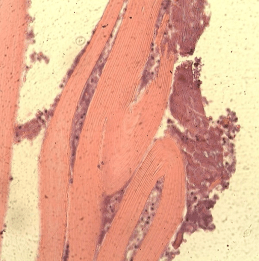Histopathology slide of hydatid disease specimen