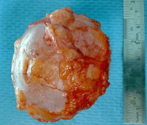 Excised intact hydatid cyst specimen