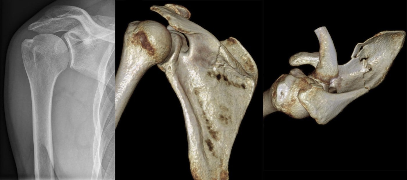 AP radiograph and 3D CT volume-rendered reconstructions of a scapular fracture extending into the glenoid.