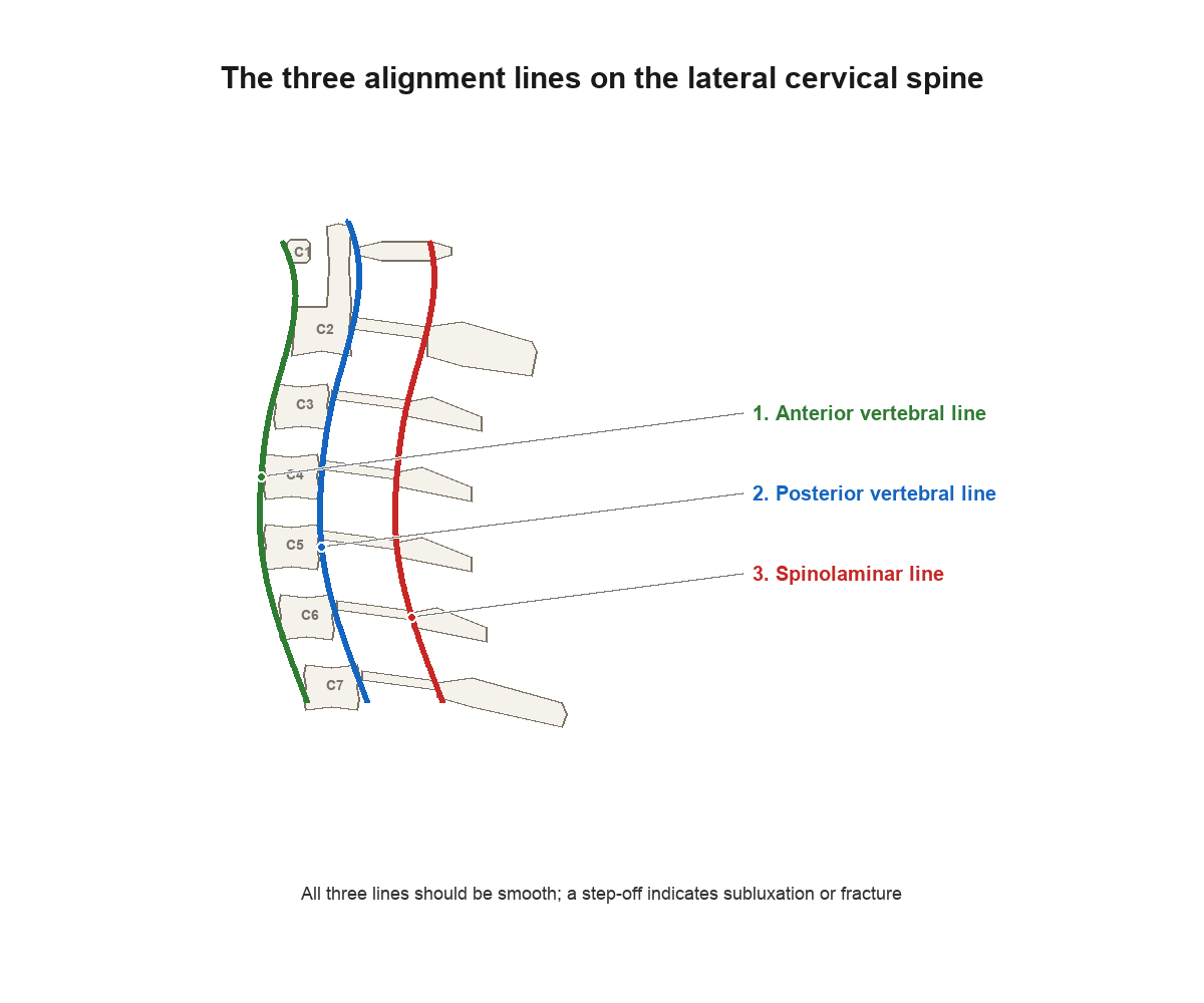 Lateral cervical spine diagram showing the three alignment lines - anterior vertebral, posterior vertebral and spinolaminar