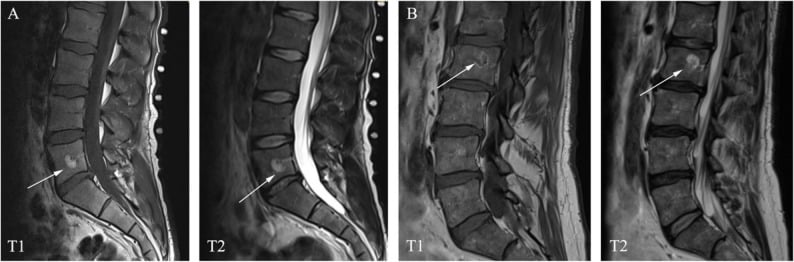 Sagittal T1 and T2 lumbar spine MRI series showing vertebral signal variations