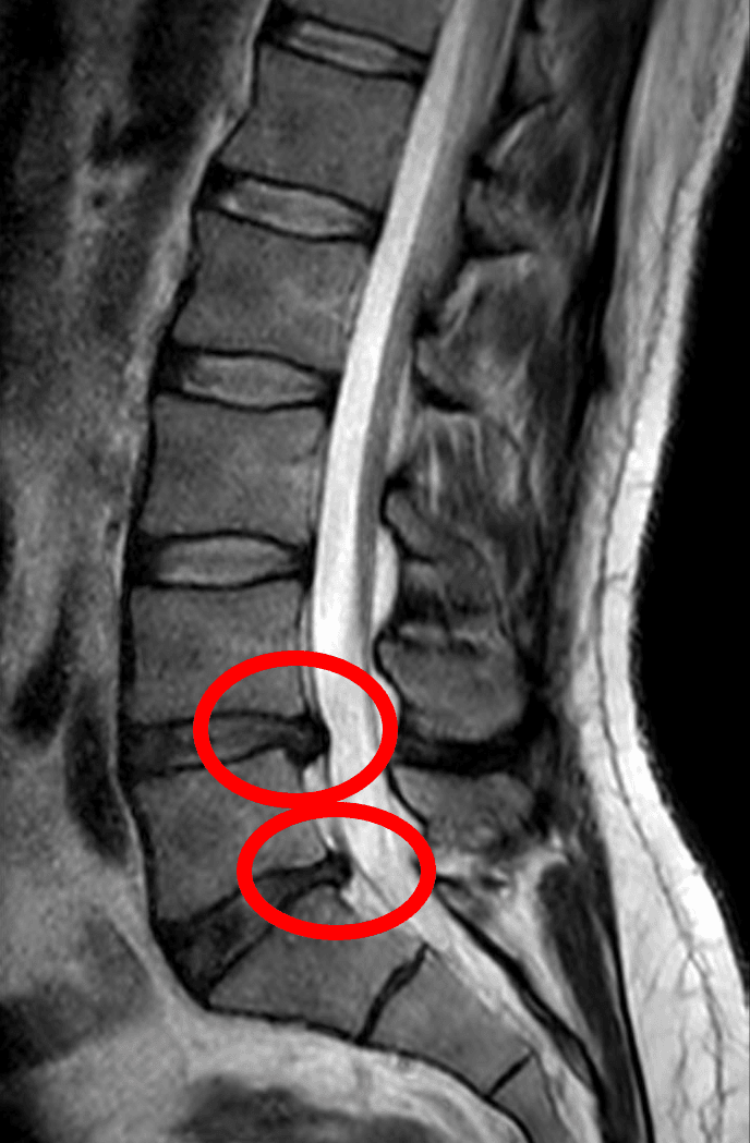 Sagittal T1, T2 and 3D axial MRI of the lumbar spine demonstrating L4-L5 disc herniation
