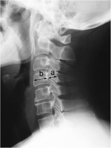 Lateral cervical radiograph demonstrating measurement of Pavlov's ratio