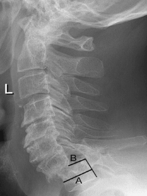 Lateral radiograph of the cervical spine showing C7-T1 spondylolisthesis and canal measurements