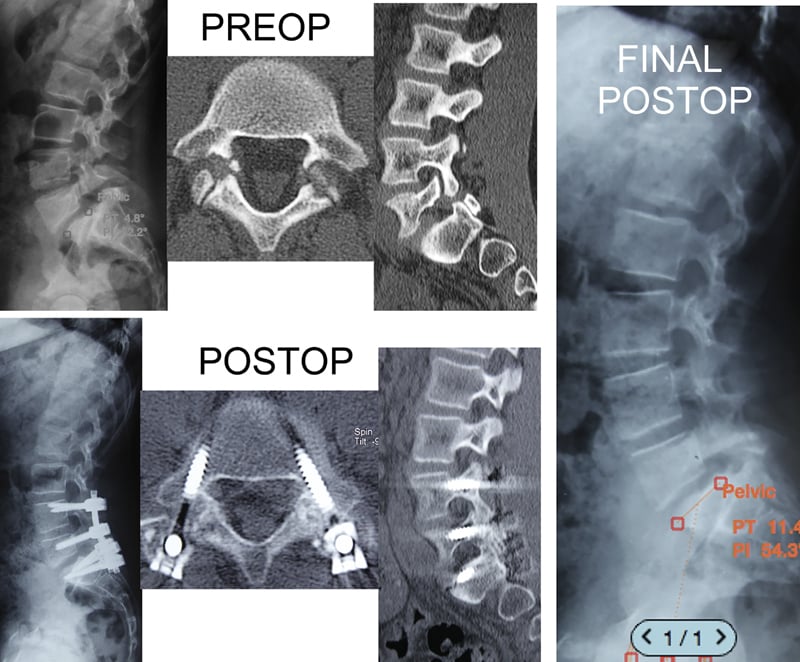 Anteroposterior and lateral radiographs showing spondylolisthesis reduction and hardware placement