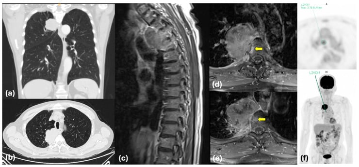 Chest CT, thoracic MRI and PET/CT staging for vertebral metastatic disease