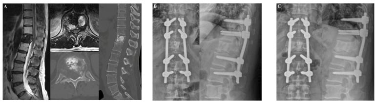 Sagittal MRI, CT and postoperative radiographs of T12 spinal metastasis before and after surgery