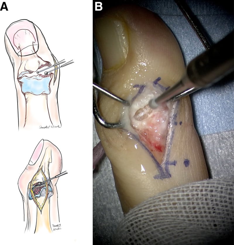 Preoperative PA and lateral radiographs of severe DIP joint osteoarthritis