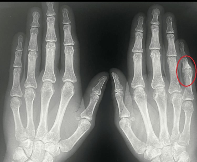 Hand PA and lateral radiographs demonstrating severe PIP joint osteoarthritis