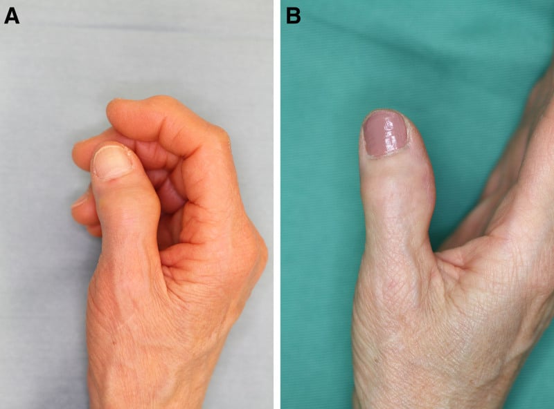 Postoperative PA and lateral radiographs of DIP joint arthrodesis with headless compression screw