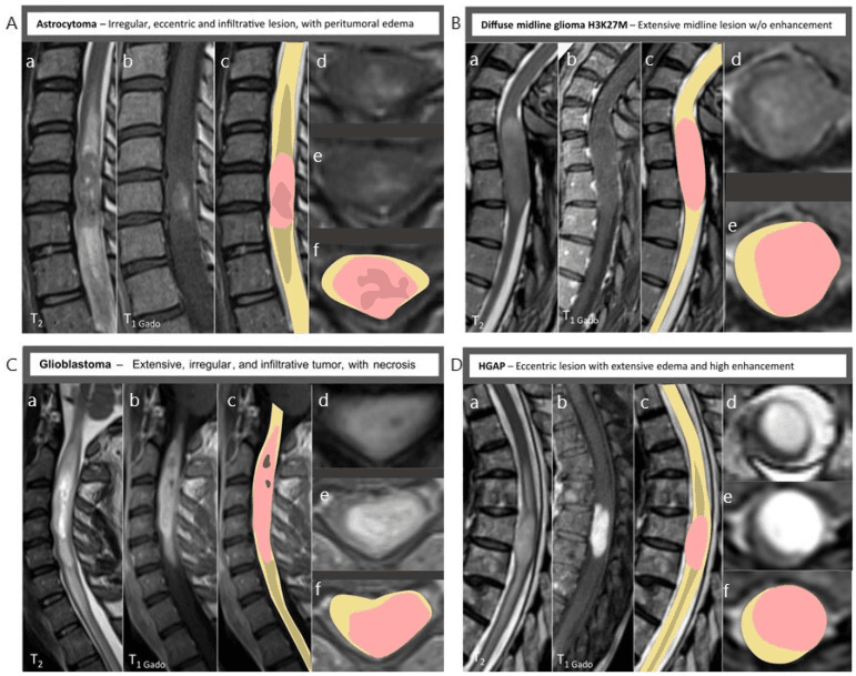 MRI panels of four infiltrative intramedullary tumours: astrocytoma, diffuse midline glioma H3K27M, glioblastoma and HGAP