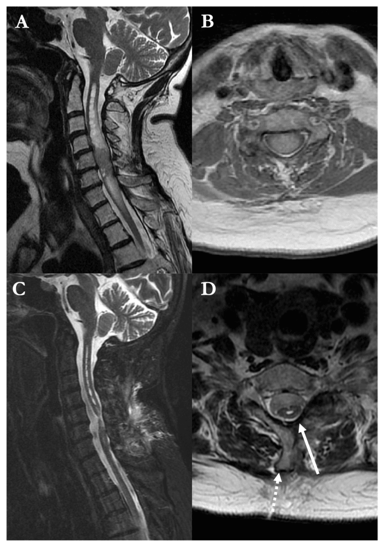 Preoperative and postoperative sagittal and axial MRI of an ill-defined, expansile intramedullary astrocytoma