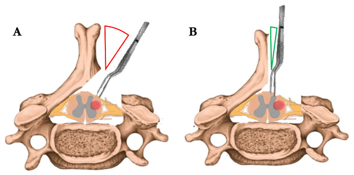 Axial schematic of a unilateral posterior exposure before and after medial undercutting of the spinous process base, showing the change in instrument angle to the cord