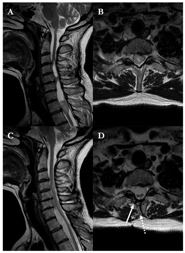 Preoperative and postoperative sagittal and axial MRI of an intramedullary ependymoma with a syrinx above it