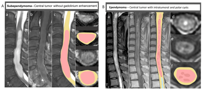 MRI panels of two central intramedullary tumours: a subependymoma without gadolinium enhancement and an ependymoma with intratumoral and polar cysts