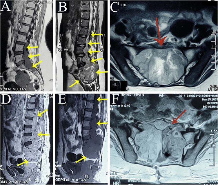 Sagittal and axial MRI of a giant myxopapillary ependymoma occupying the lumbar canal and extending into the sacrum