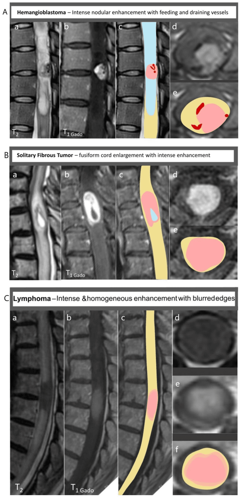 MRI panels of three intensely enhancing intramedullary lesions: haemangioblastoma, solitary fibrous tumour and lymphoma