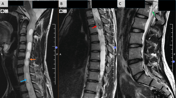 Sagittal T2-weighted MRI of the spine showing a haemangioblastoma with internal flow voids within a long multiloculated syrinx