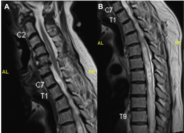 Sagittal MRI of the cervicothoracic and thoracic spine with a long syrinx in the cord
