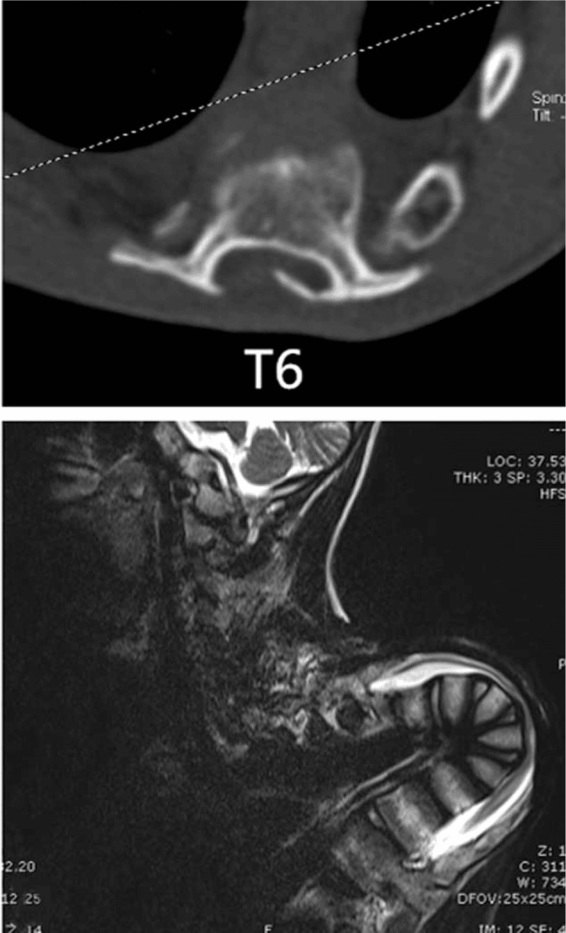 Axial CT labelled T6 and sagittal T2-weighted MRI of a post-laminectomy kyphosis with the spinal cord draped over the apex
