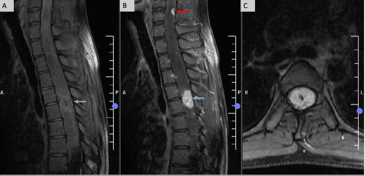 Sagittal and axial contrast MRI of the spine showing an enhancing intramedullary nodule and a second, smaller enhancing focus higher in the cord