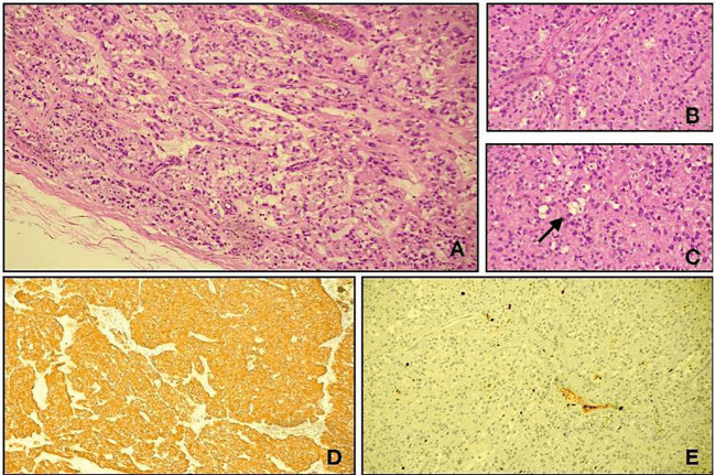 Myxopapillary ependymoma histology: three haematoxylin and eosin panels and two immunostained panels
