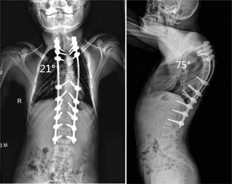 PA and lateral radiographs after long-segment instrumented reconstruction of post-laminectomy deformity, marked as a 21-degree coronal curve and a 75-degree kyphosis
