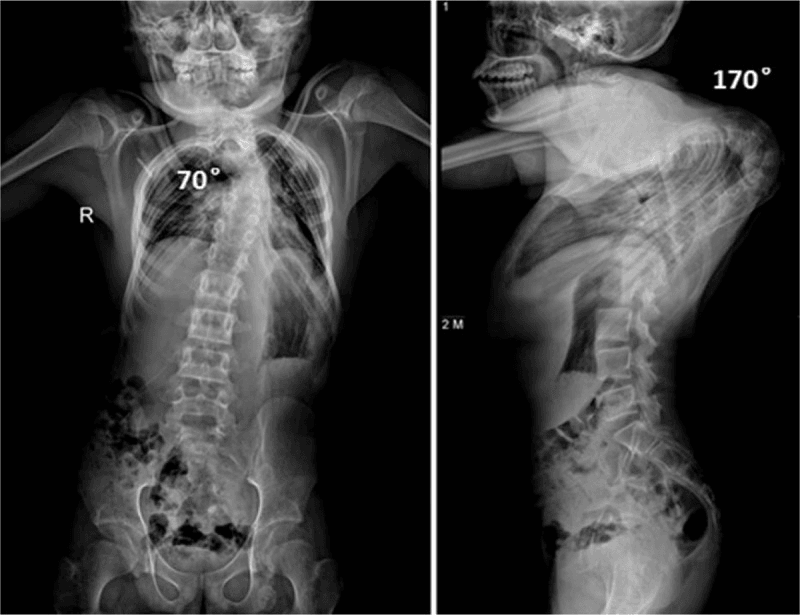 PA and lateral radiographs of severe post-laminectomy deformity, marked as a 70-degree coronal curve and a 170-degree kyphosis