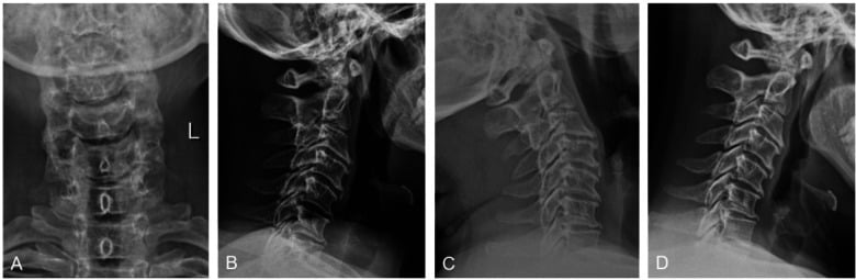 Anteroposterior and lateral cervical radiographs showing degeneration with loss of normal curvature