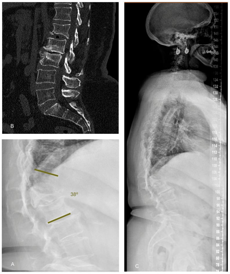 Radiographs of an L3 fracture with preserved posterior wall and regional kyphosis measured